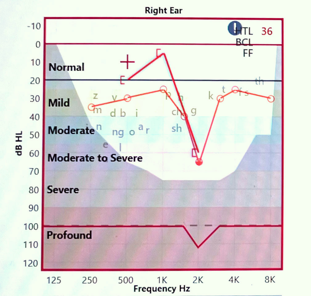 audiogram right ear